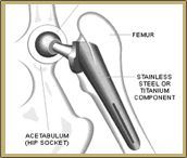 DePuy Hip Implant Device Guide