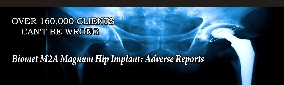 Biomet M2A Magnum Hip Implant: Adverse Reports