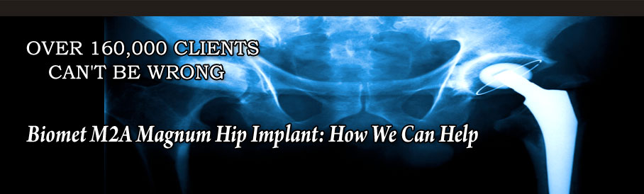 Biomet M2A Magnum Hip Implant: How We Can Help